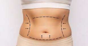 What Should You Avoid After Tummy Tuck in Islamabad?